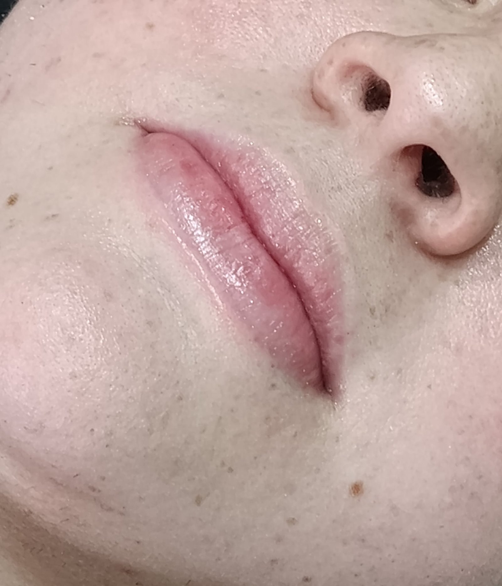 Revitalizacion Labial